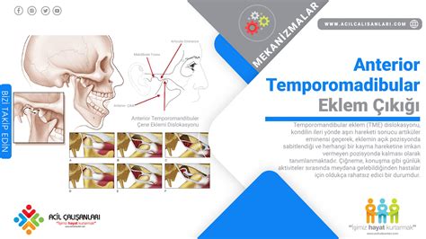 temporomandibular eklem çıkığı tedavisi